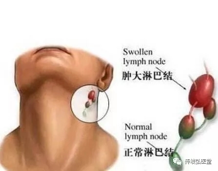 传岐弘医堂:淋巴结炎如何治疗效果更好?