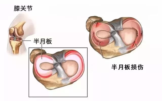 弘医堂:半月板损伤是年轻人的"专利"?中老年人切不可大意!